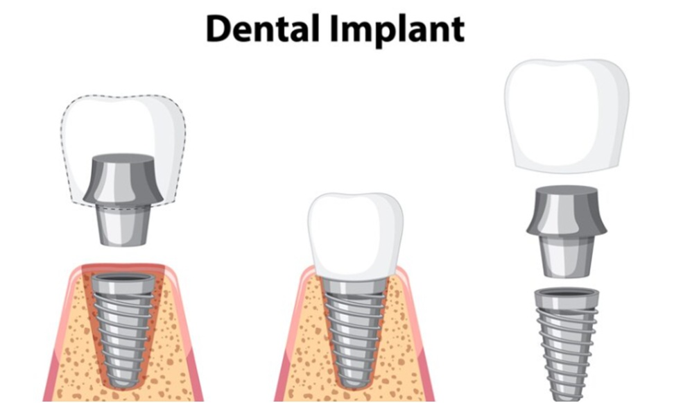 Dental Implants Help with Severe Tooth Decay and Damage